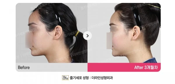 Fat Grafting before-and-after photo, before surgery - TheLINE Plastic Surgery
