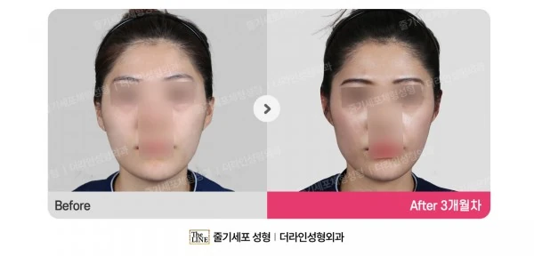 Fat Grafting before-and-after photo, before surgery - TheLINE Plastic Surgery