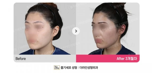 Fat Grafting before-and-after photo, before surgery - TheLINE Plastic Surgery