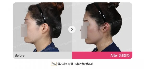Fat Grafting before-and-after photo, before surgery - TheLINE Plastic Surgery