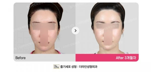 Fat Grafting before-and-after photo, before surgery - TheLINE Plastic Surgery