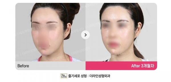 Fat Grafting before-and-after photo, before surgery - TheLINE Plastic Surgery