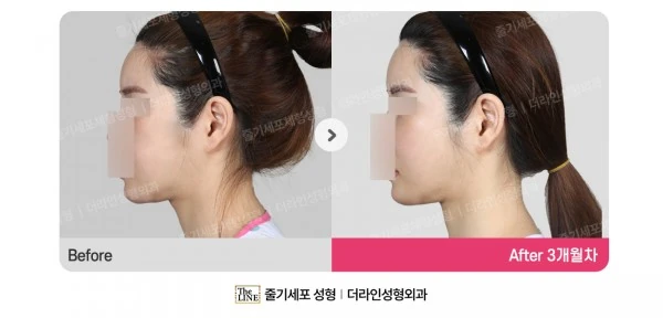 Fat Grafting before-and-after photo, before surgery - TheLINE Plastic Surgery