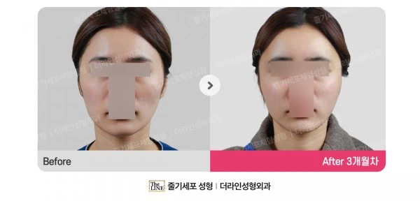 Fat Grafting before-and-after photo, before surgery - TheLINE Plastic Surgery