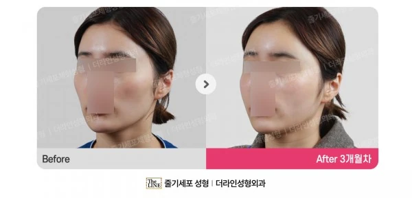 Fat Grafting before-and-after photo, before surgery - TheLINE Plastic Surgery
