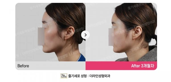 Fat Grafting before-and-after photo, before surgery - TheLINE Plastic Surgery