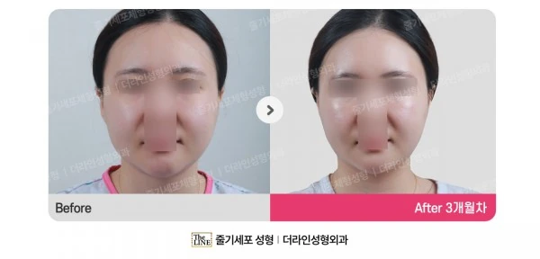 360 Full-Face Lifting before-and-after photo, before surgery - TheLINE Plastic Surgery