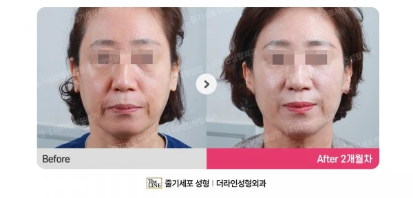 Stem Cell Lifting before-and-after photo, before surgery - TheLINE Plastic Surgery