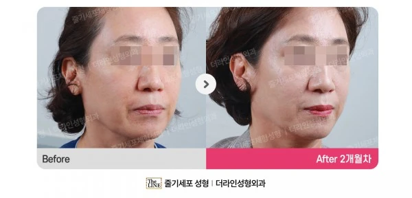 Stem Cell Lifting before-and-after photo, before surgery - TheLINE Plastic Surgery