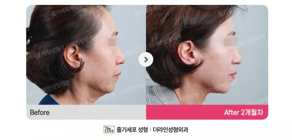 Stem Cell Lifting before-and-after photo, before surgery - TheLINE Plastic Surgery