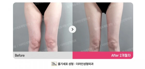 Chanel Line, Inner Thigh Liposuction, before and after 2 months at Seoul Lipo Center