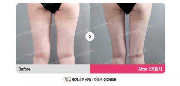Chanel Line, Inner Thigh Liposuction before-and-after photo, before surgery - TheLINE Plastic Surgery