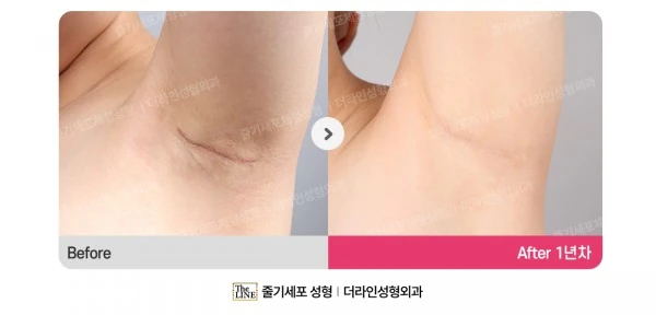 Incision Site After Breast Surgery before-and-after photo, before surgery - TheLINE Plastic Surgery