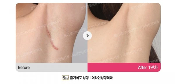 Incision Site After Breast Surgery before-and-after photo, before surgery - TheLINE Plastic Surgery