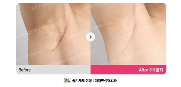 Incision Site After Breast Surgery before-and-after photo, before surgery - TheLINE Plastic Surgery