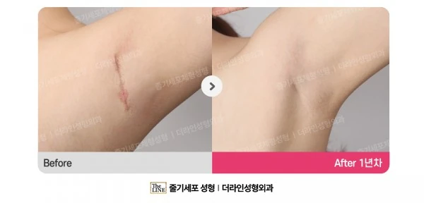 Incision Site After Breast Surgery before-and-after photo, before surgery - TheLINE Plastic Surgery