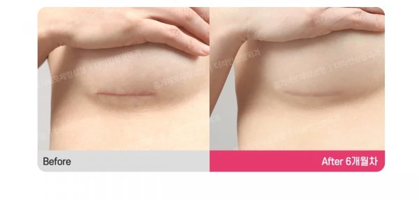 Incision Site After Breast Surgery_Infra before-and-after photo, before surgery - TheLINE Plastic Surgery