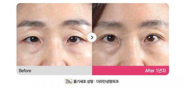 Upper Blepharoplasty, Epicanthoplasty before-and-after photo, before surgery - TheLINE Plastic Surgery
