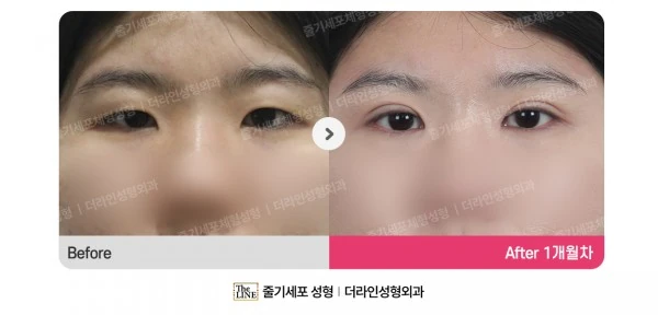 Incisional Double Eyelid (LT Ptosis Corr before-and-after photo, before surgery - TheLINE Plastic Surgery