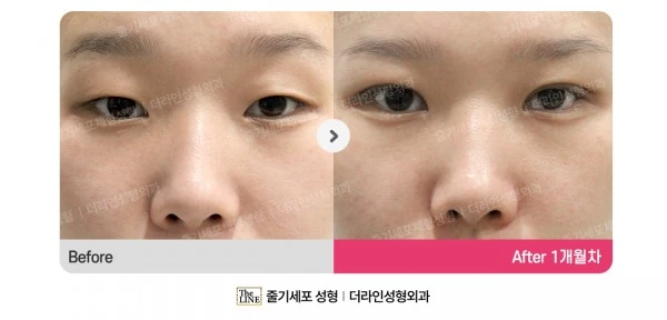 Ptosis Correction before-and-after photo, before surgery - TheLINE Plastic Surgery