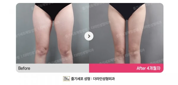Thigh Liposuction, Hip Fat Grafting, before and after 4 months at Seoul Lipo Center