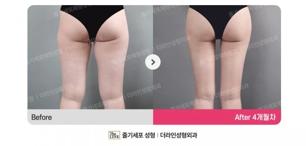 Thigh Liposuction, Hip Fat Grafting before-and-after photo, before surgery - TheLINE Plastic Surgery