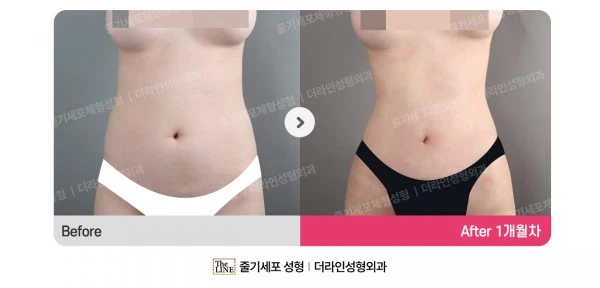 Abdominal Liposuction before-and-after photo, before surgery - TheLINE Plastic Surgery