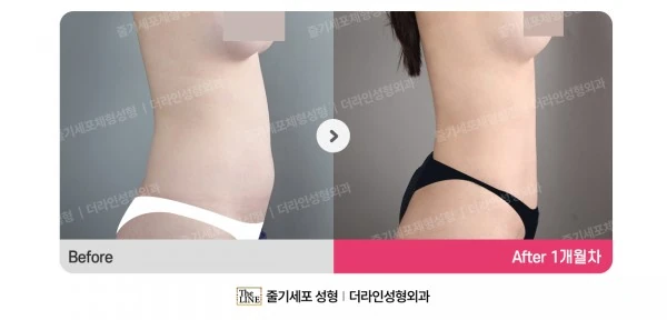 Abdominal Liposuction before-and-after photo, before surgery - TheLINE Plastic Surgery