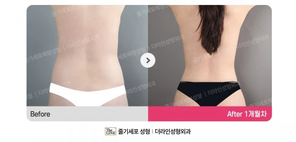 Abdominal Liposuction before-and-after photo, before surgery - TheLINE Plastic Surgery