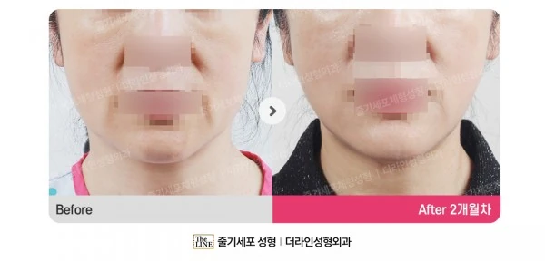 360° Full Face before-and-after photo, before surgery - TheLINE Plastic Surgery