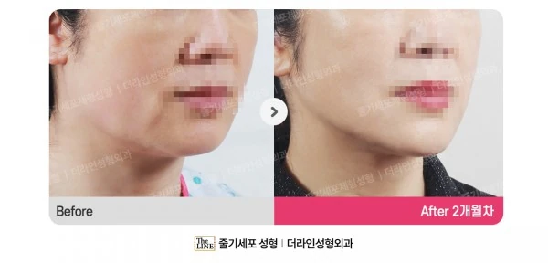 360° Full Face before-and-after photo, before surgery - TheLINE Plastic Surgery