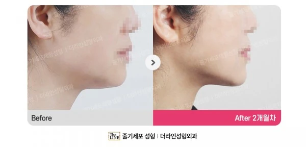360° Full Face before-and-after photo, before surgery - TheLINE Plastic Surgery
