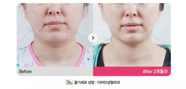 360° Full Face before-and-after photo, before surgery - TheLINE Plastic Surgery