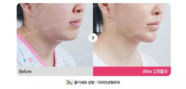 360° Full Face before-and-after photo, before surgery - TheLINE Plastic Surgery