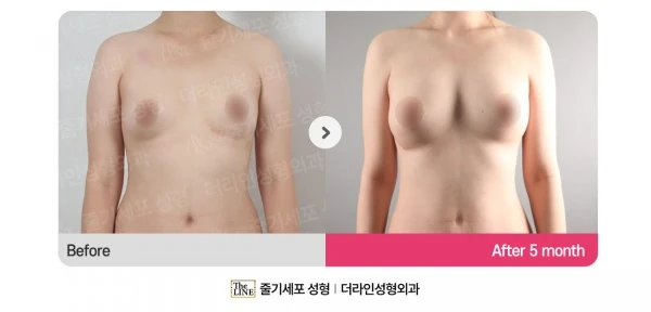 Breast Fat Grafting before-and-after photo, before surgery - TheLINE Plastic Surgery