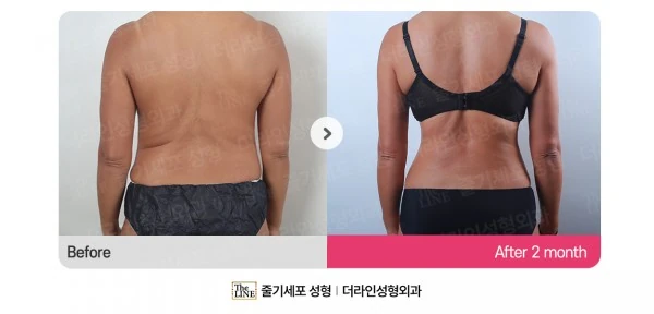 Abdominal Lift + Abdominal Liposuction before-and-after photo, before surgery - TheLINE Plastic Surgery
