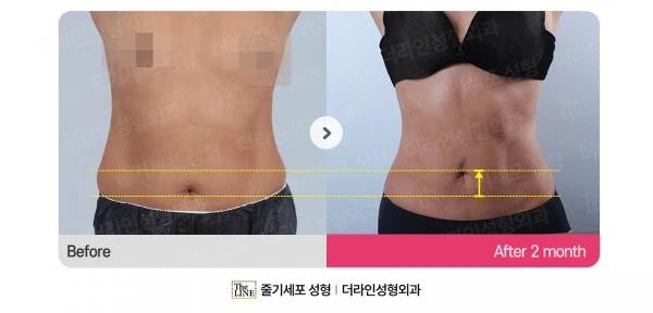 Abdominal Lift + Abdominal Liposuction before-and-after photo, before surgery - TheLINE Plastic Surgery