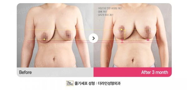 Breast Lift + Breast Implants before-and-after photo, before surgery - TheLINE Plastic Surgery