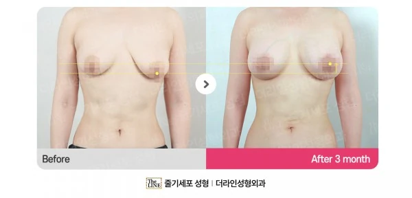Breast Lift + Breast Implants before-and-after photo, before surgery - TheLINE Plastic Surgery