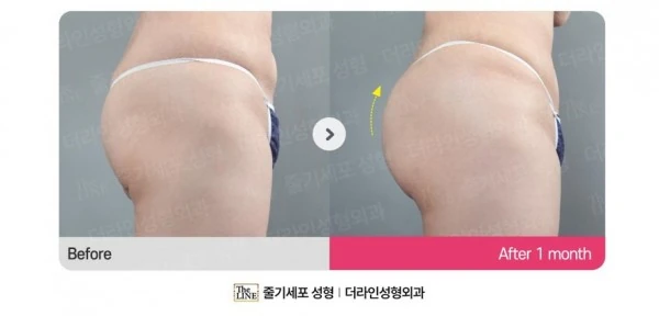 Hip Fat Grafting before-and-after photo, before surgery - TheLINE Plastic Surgery