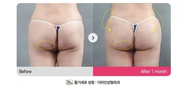 Hip Fat Grafting before-and-after photo, before surgery - TheLINE Plastic Surgery