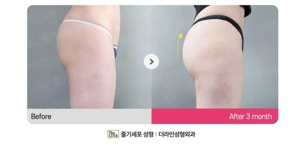 Hip Fat Grafting before-and-after photo, before surgery - TheLINE Plastic Surgery