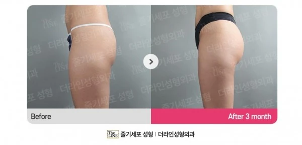 Hip Fat Grafting before-and-after photo, before surgery - TheLINE Plastic Surgery