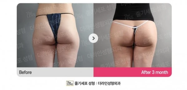 Hip Fat Grafting before-and-after photo, before surgery - TheLINE Plastic Surgery