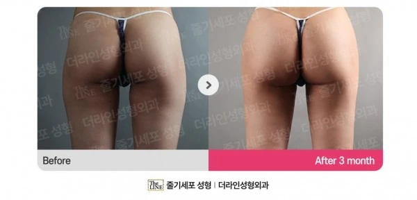 Hip Fat Grafting before-and-after photo, before surgery - TheLINE Plastic Surgery