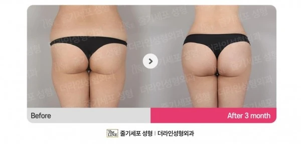 Hip Fat Grafting before-and-after photo, before surgery - TheLINE Plastic Surgery