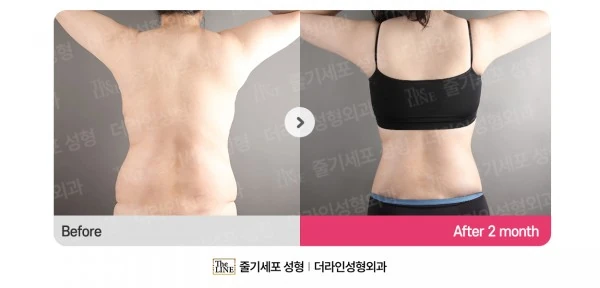 Abdomen + Corset Liposuction before-and-after photo, before surgery - TheLINE Plastic Surgery