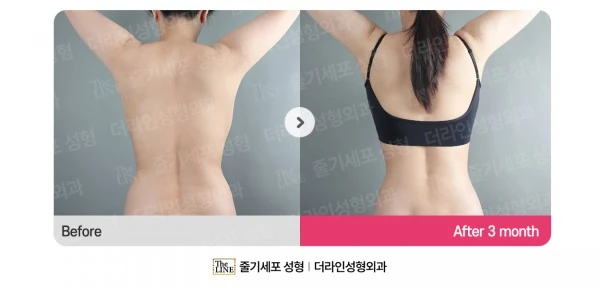 Abdomen + Corset Liposuction before-and-after photo, before surgery - TheLINE Plastic Surgery