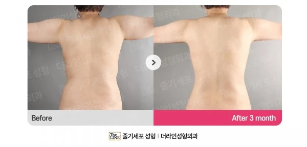 Abdomen + Corset Liposuction before-and-after photo, before surgery - TheLINE Plastic Surgery