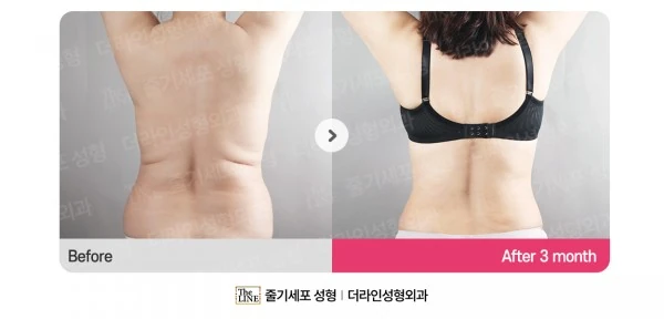 Abdomen + Corset Liposuction before-and-after photo, before surgery - TheLINE Plastic Surgery